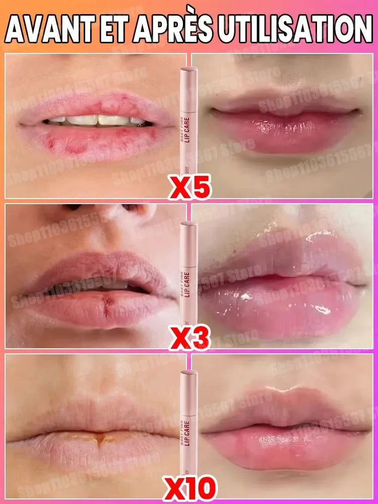 Perfect lip augmentation-Sexy and plump lip shape