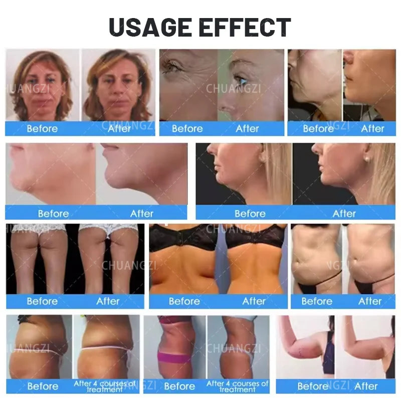 Portable NEO Device Slimming Machine Ultrasonic Fat Removal Wrinkle Removal Face Slimming Double Handle Super Strong 360 Degree
