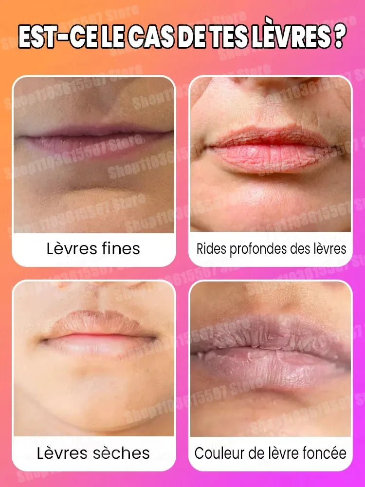 Perfect lip augmentation-Sexy and plump lip shape