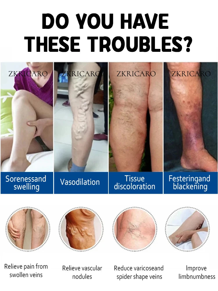 Improve spider legs within 7 days; ʙʟᴜᴇ ʟɪɢʜᴛ ᴘᴇɴ ᴛᴏ ᴀʟʟᴇᴠɪᴀᴛᴇ ʟᴇɢ ᴘʀᴏʙʟᴇᴍs.