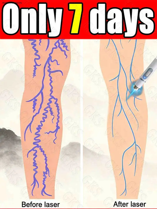 Improve spider legs within 7 days; ʙʟᴜᴇ ʟɪɢʜᴛ ᴘᴇɴ ᴛᴏ ᴀʟʟᴇᴠɪᴀᴛᴇ ʟᴇɢ ᴘʀᴏʙʟᴇᴍs.